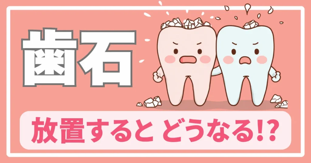 歯石ができる仕組み・取るタイミング・放置するとどうなるか