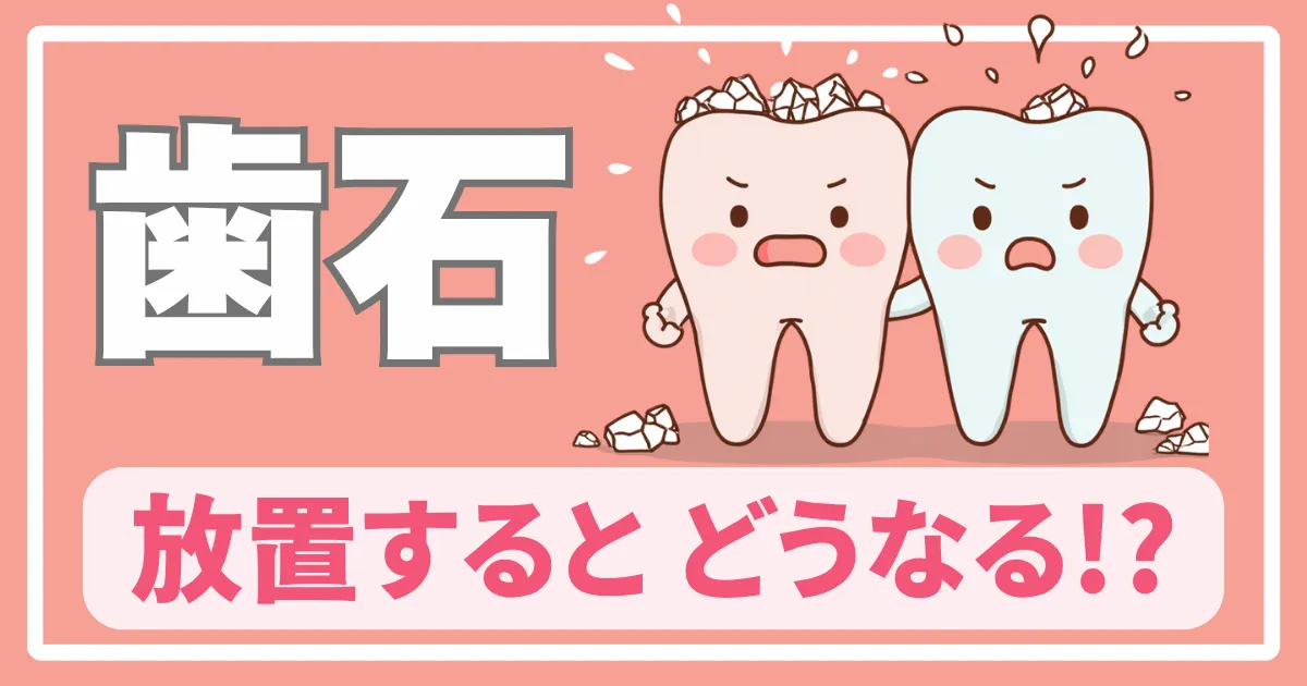 歯石ができる仕組み・取るタイミング・放置するとどうなるか